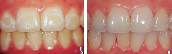 Деминерализация эмали зубов